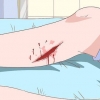 Behandling av celluliter