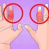 Behandla ett brutet finger