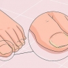 Bota en svampnagel