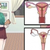 Behandling av vaginalcystor