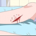 Behandling av celluliter