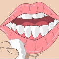 Cheilit exfoliativ botemedel