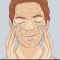 Exfoliera huden