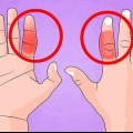 Behandla ett brutet finger