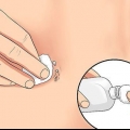 Behandlar en irriterad navelpiercing