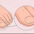 Bota en svampnagel