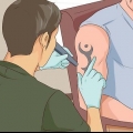 Ta bort en tatuering