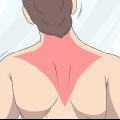Återställa en trapezius-stam
