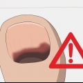 Hur man behandlar en svart tånagel