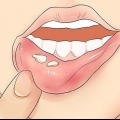 Känner igen herpes