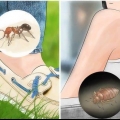 Känn igen insektsbett