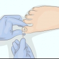 Bota onycholysis