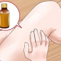 Behandla ringorm: kan det naturligt?