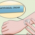 Behandla ringorm