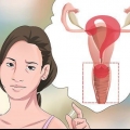 Diagnostisera vaginal flytning