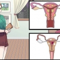 Behandling av vaginalcystor