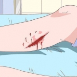 Behandling av celluliter