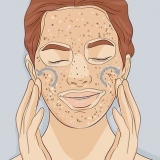 Exfoliera huden