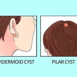 Behandling av en cysta