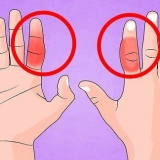 Behandla ett brutet finger