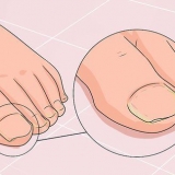 Bota en svampnagel