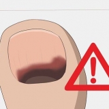 Hur man behandlar en svart tånagel