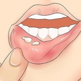 Känner igen herpes