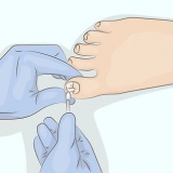 Bota onycholysis