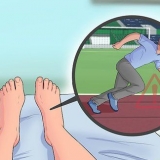 Behandling av plantar fasciit