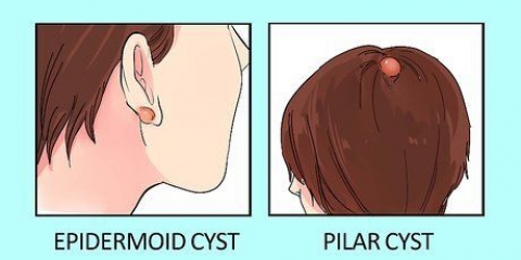 Behandling av en cysta