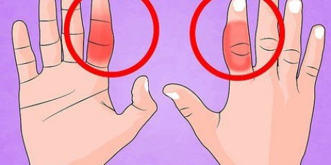 Behandla ett brutet finger