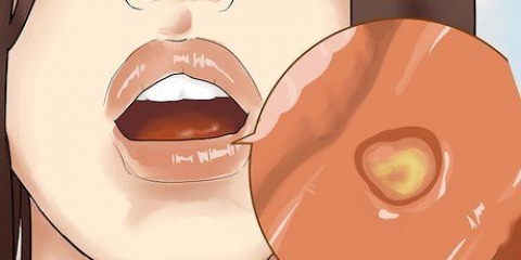Läka en inflammation i munnen