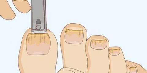 Bota en svampnagel: kan det göras med vinäger?