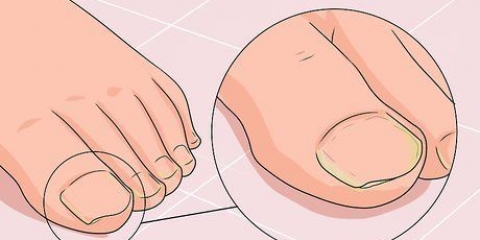 Bota en svampnagel