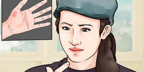 Behandla ett finger du slår med en hammare