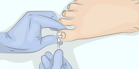 Bota onycholysis