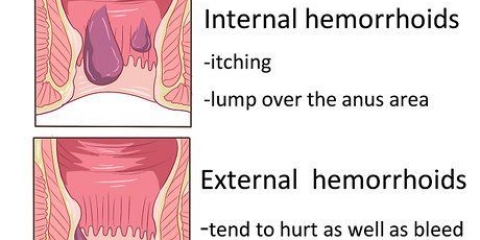 Hur man blir av med hemorrojder naturligt