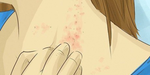 Behandling av svamphudinfektioner: kan det naturligt?