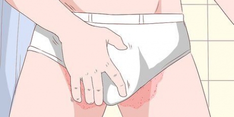 Behandling av tinea cruris med sudocrem