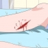 Behandling av celluliter