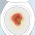 Att känna igen symtomen på tjocktarmscancer