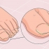 Bota en svampnagel